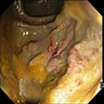 Colonoscopy showing deep ulcers in the sigmoid colon