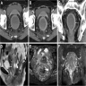 Postcolectomy CT and MRI