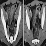 Segmental wall thickening