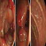 polypoid and patchy lesions