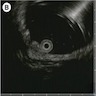 Homogenous hypoechoic submucosal lesion