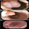 Pedunculated polyp