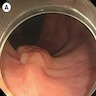 Polypoid lesion with nodular surface