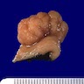 Polypoid tumor with gyrated surface sitting on a short stalk