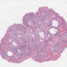 Juvenile polyposis syndrome histology