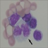 Monocytoid cells with irregular nucleus