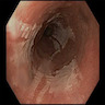 Vertical white sloughing mucosal strips