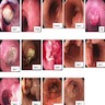 Endoscopic findings