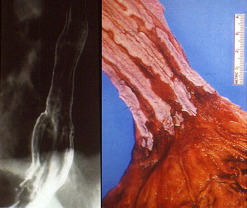 Pathology Outlines - Reflux esophagitis / gastroesophageal ...