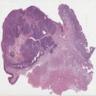 Invasive basaloid squamous cell carcinoma