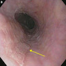 Epidermoid metaplasia