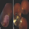 Fundoscopic image demonstrating tumor