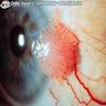 conjunctival papilloma excision