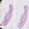 STK11 adnexal tumor