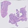 STK11 adnexal tumor