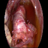 Laparoscopic findings