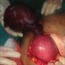 Torsed paraovarian cyst before detorsion