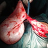 Large paraovarian cyst