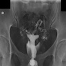 Small outpouching or diverticula
