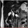 Type I, MRCP