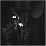 Type III, MRCP