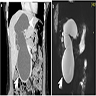 Type IV, MRCP