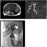 Type V, MRCP & PTC