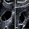 Hyperechoic homogeneous pedunculated polyps