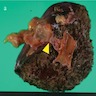 Thickened gallbladder mucosa