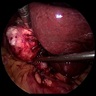 Intraoperative