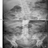 Xray with thin calcifications