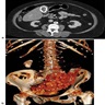 CT with calcifications