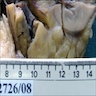 Renal pelvic lesion