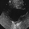 Ultrasound