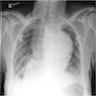 Chest radiograph