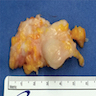 Large resected neuroma