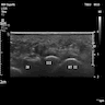 Morton neuroma on ultrasound