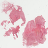 Rheumatoid nodules