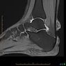 MRI of rheumatoid nodules