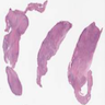 Rheumatoid nodules