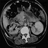 CT: gas in renal parenchyma, and pararenal space