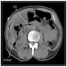 CT: gas in kidney and IVC