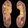 Areas of papillary necrosis
