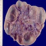 Cysts are smooth lined, no normal kidney tissue is apparent