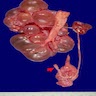 With ipsilateral hypoplasia of ureter
