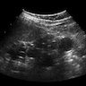 Multicystic renal dysplasia