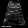 Multicystic renal dysplasia