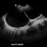 Multicystic renal dysplasia