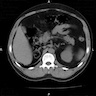 Unilateral renal agenesis