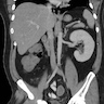 Unilateral renal agenesis